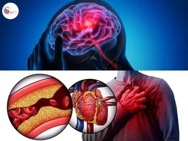หลอดเลือดสมองและหลอดเลือดหัวใจ เกิดการอุดตัน