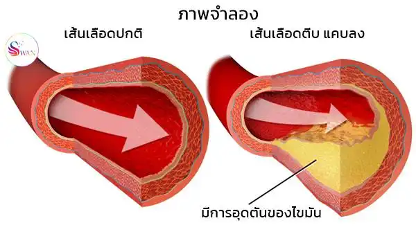 หลอดเลือดที่เป็นปกติ กับ หลอดเลือดที่มีไขมันอุดตัน ทำให้ตีบ แคบลง